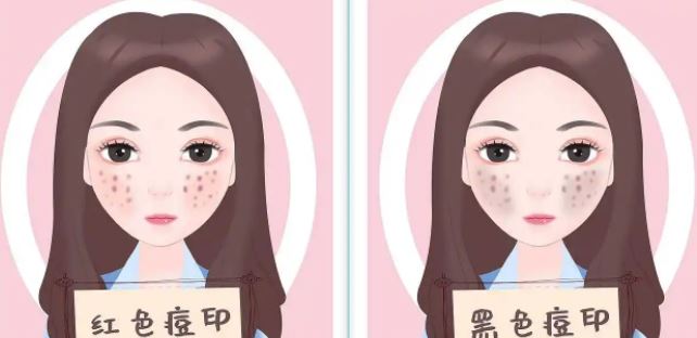 臉上紅色痘印幾個(gè)月都不消怎么辦？紅色痘印應(yīng)該怎么消除？