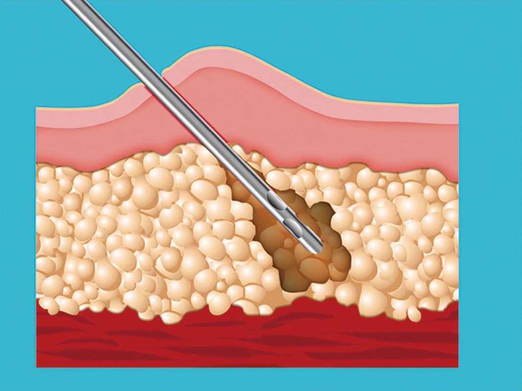胸太大可以抽脂嗎多少錢？
