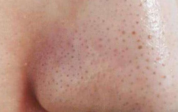 清潔面膜哪個牌子可以快速祛黑頭？趙薇、薇婭 推薦的紐西之謎泥膜真的好用嗎？